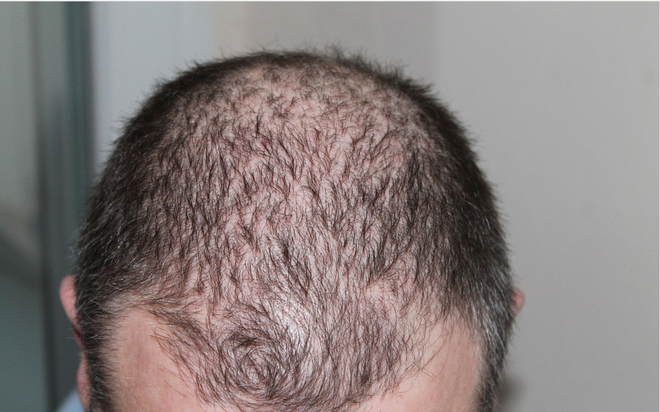 a man suffering from hair loss